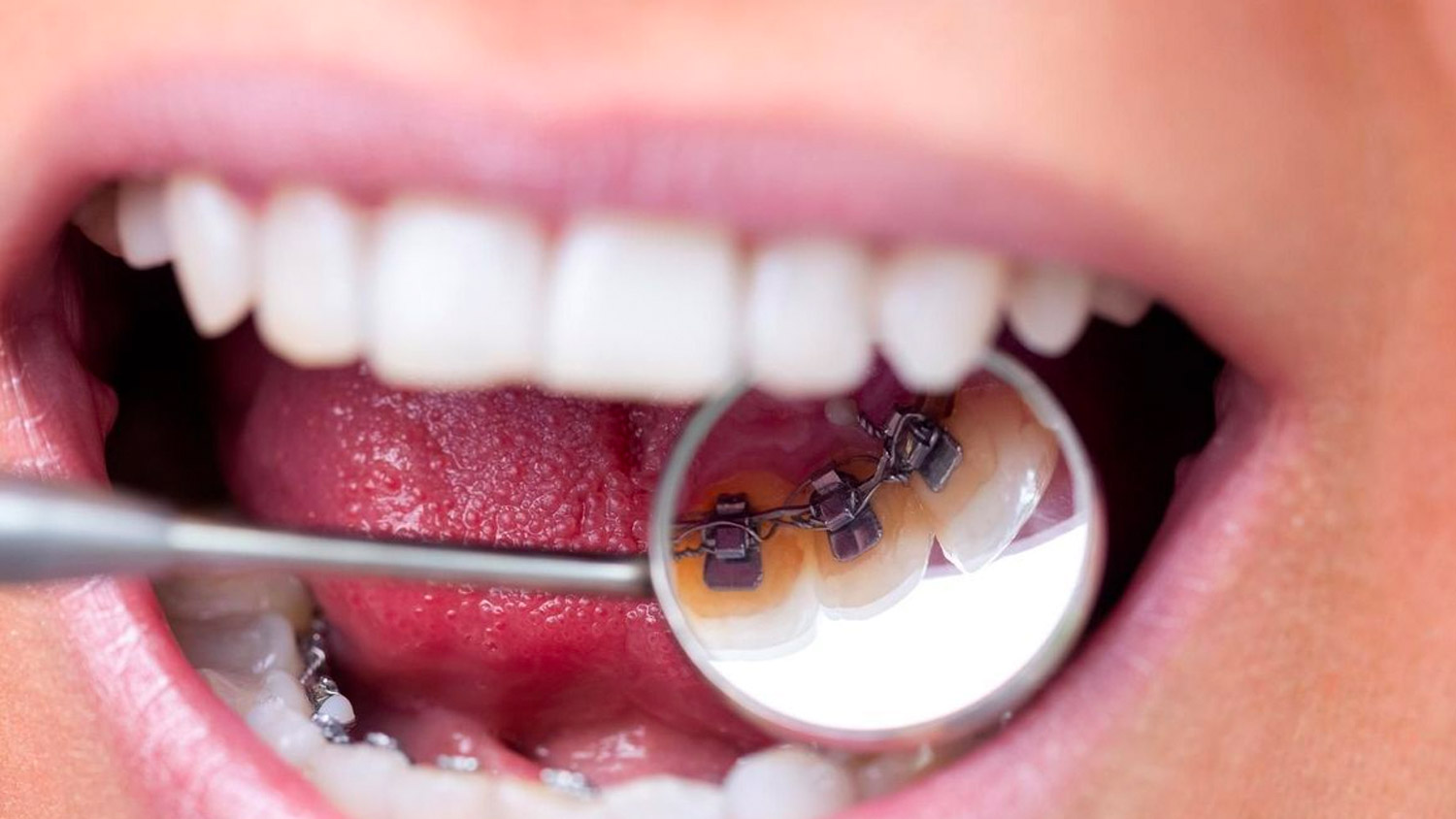 orthodontie-linguale-poissy