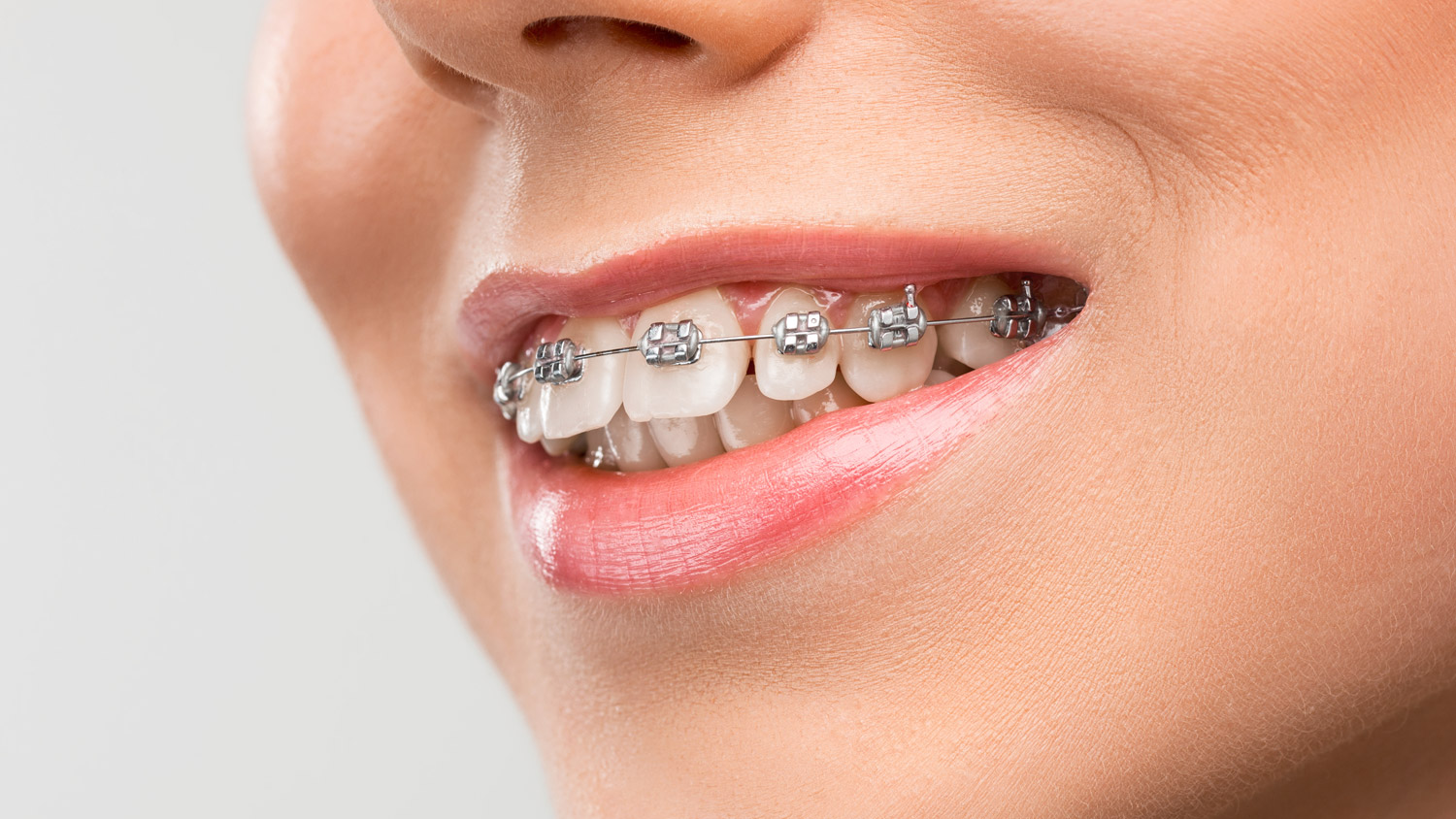 orthodontie-vestibulaire-poissy